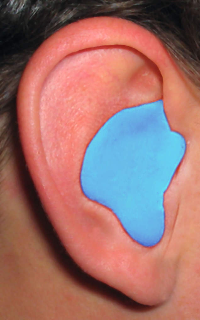 Radians Custom Molded Earplugs - CEP001